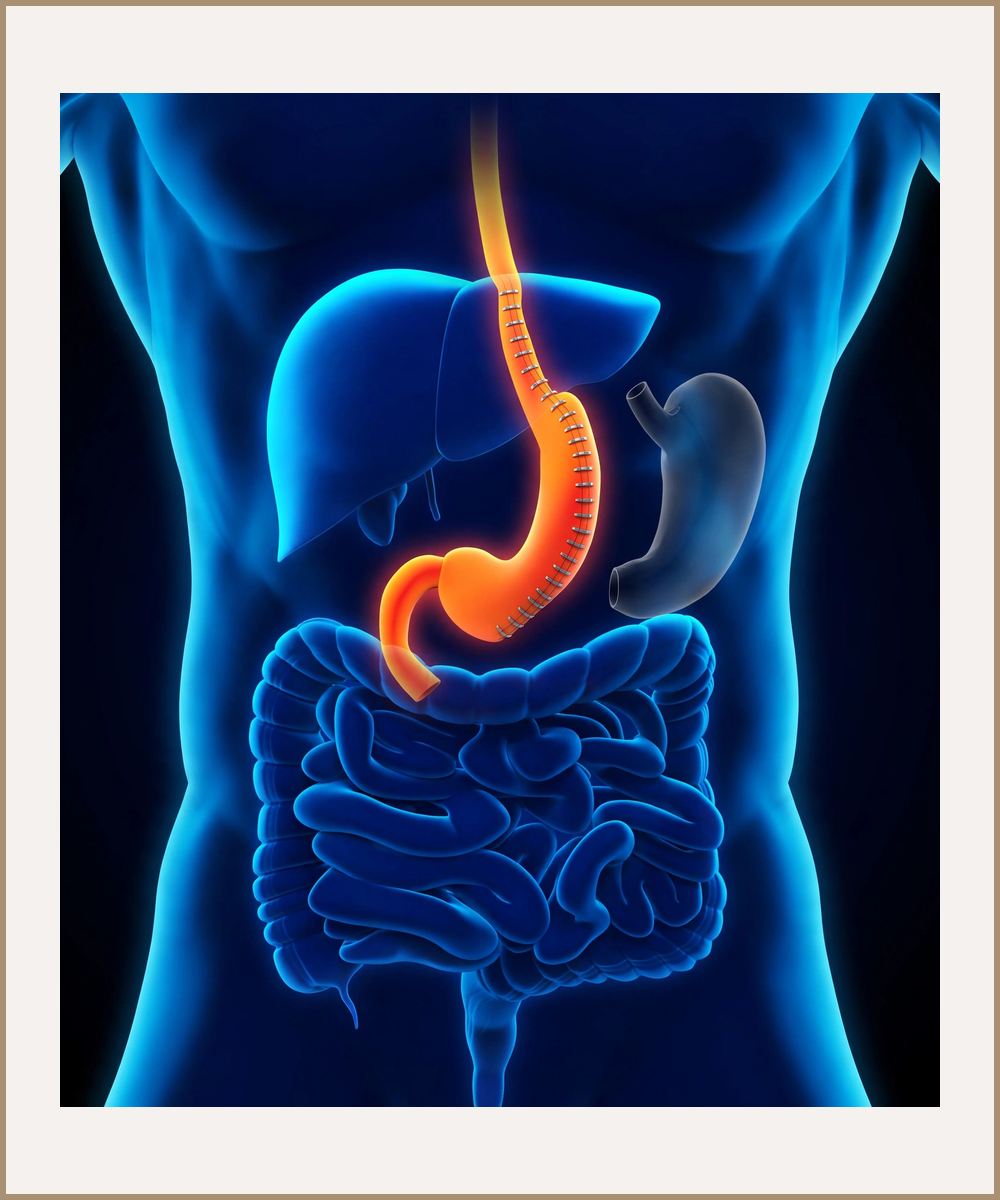 Illustration of a sleeve gastrectomy